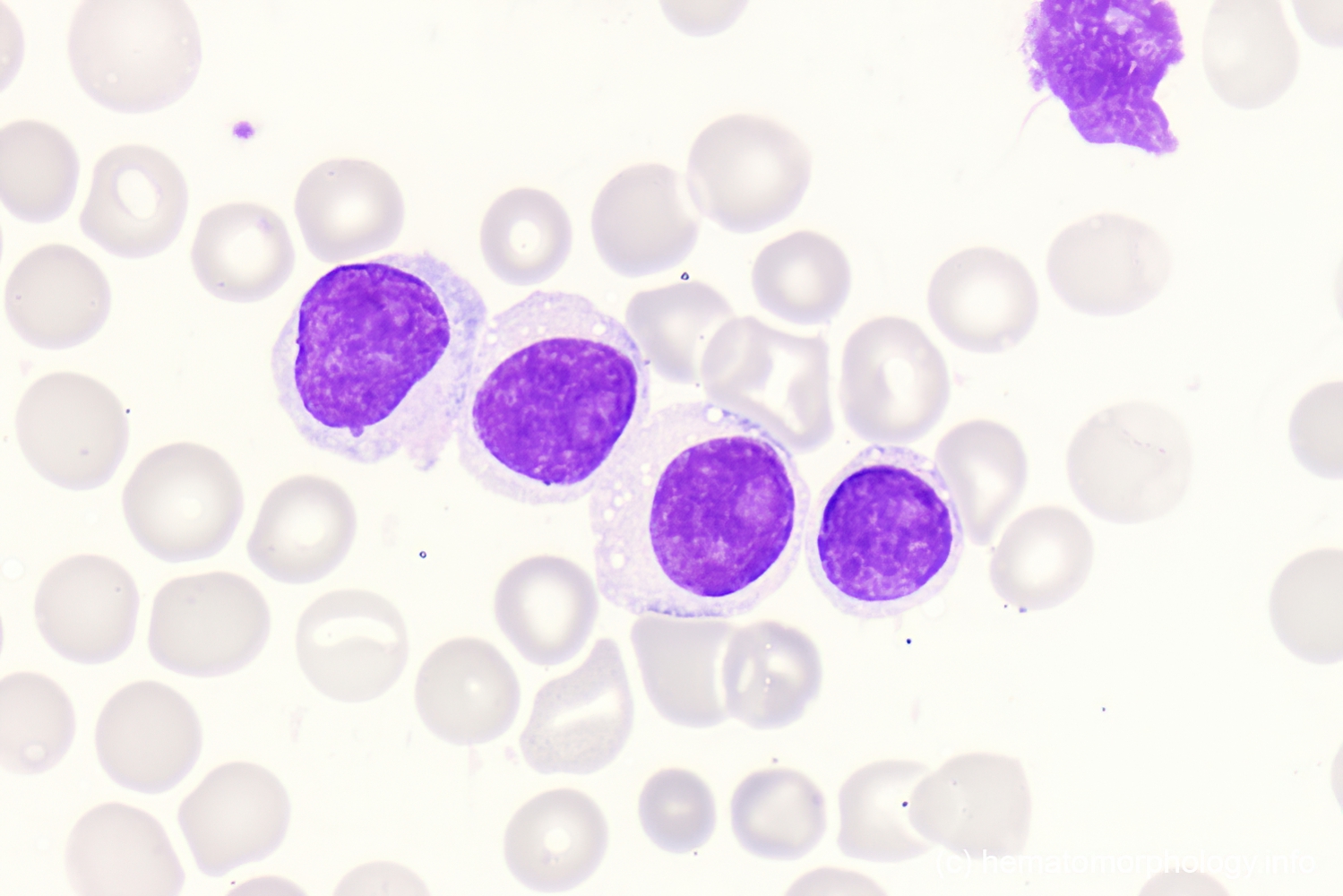 B-cell ProLymphocytic Leukemia (B-PLL) - Hematomorphology, A Databank ...