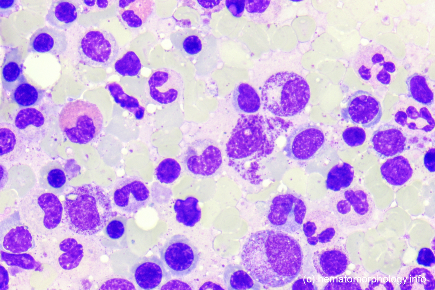 Mastocytosis - Hematomorphology, A Databank / Imagebank For Hematology ...