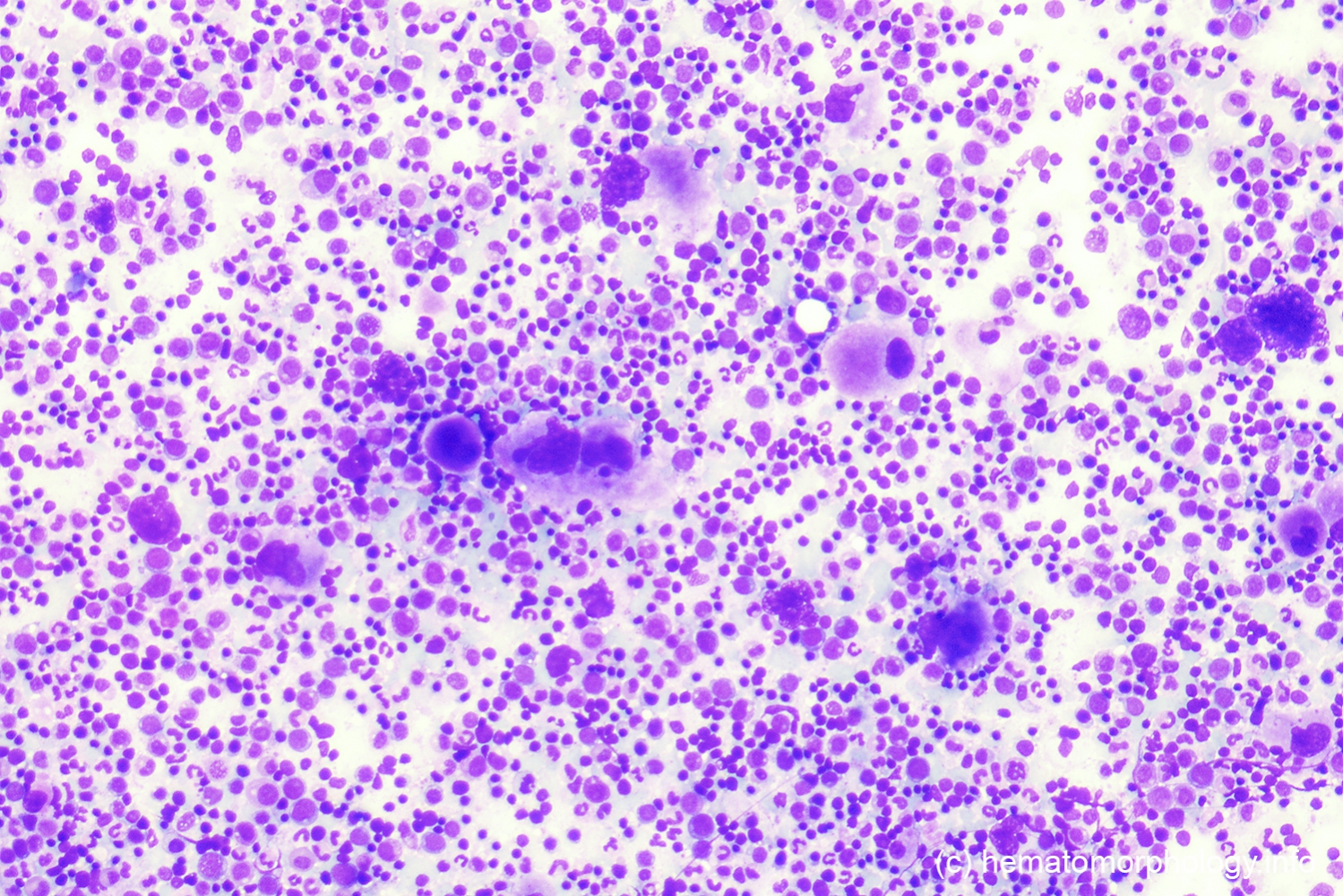 Polycythemia Vera PV Hematomorphology A Databank Imagebank For