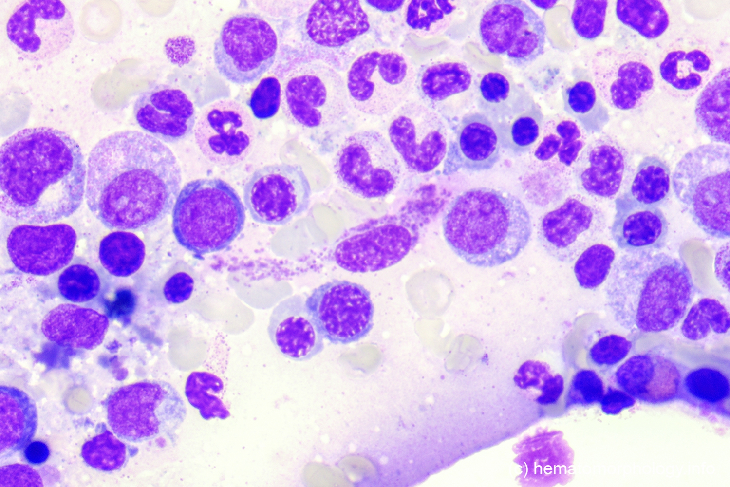 Mastocytosis - Hematomorphology, a databank / imagebank for hematology ...