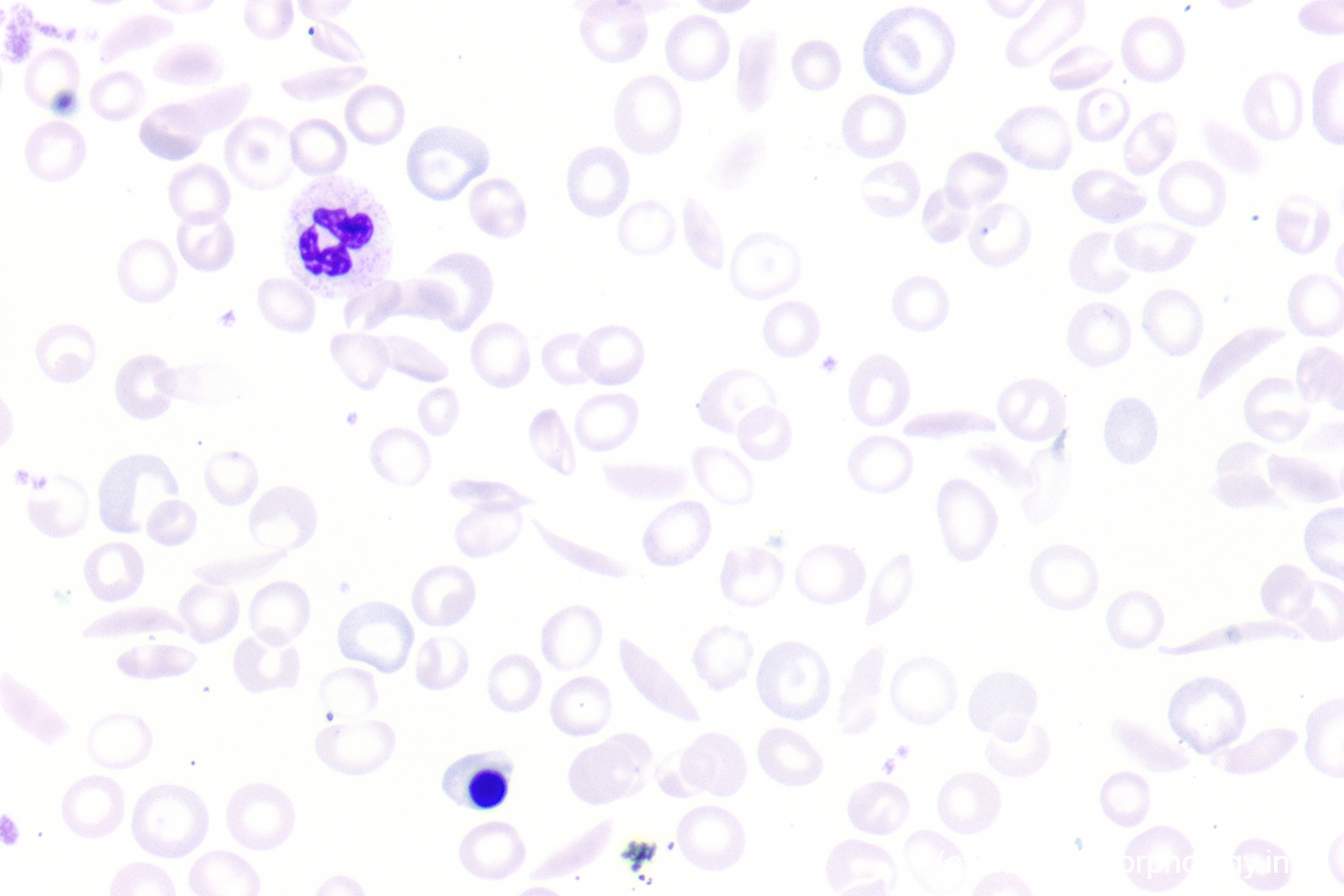 Sickle cell anemia - Hematomorphology, a databank / imagebank for ...