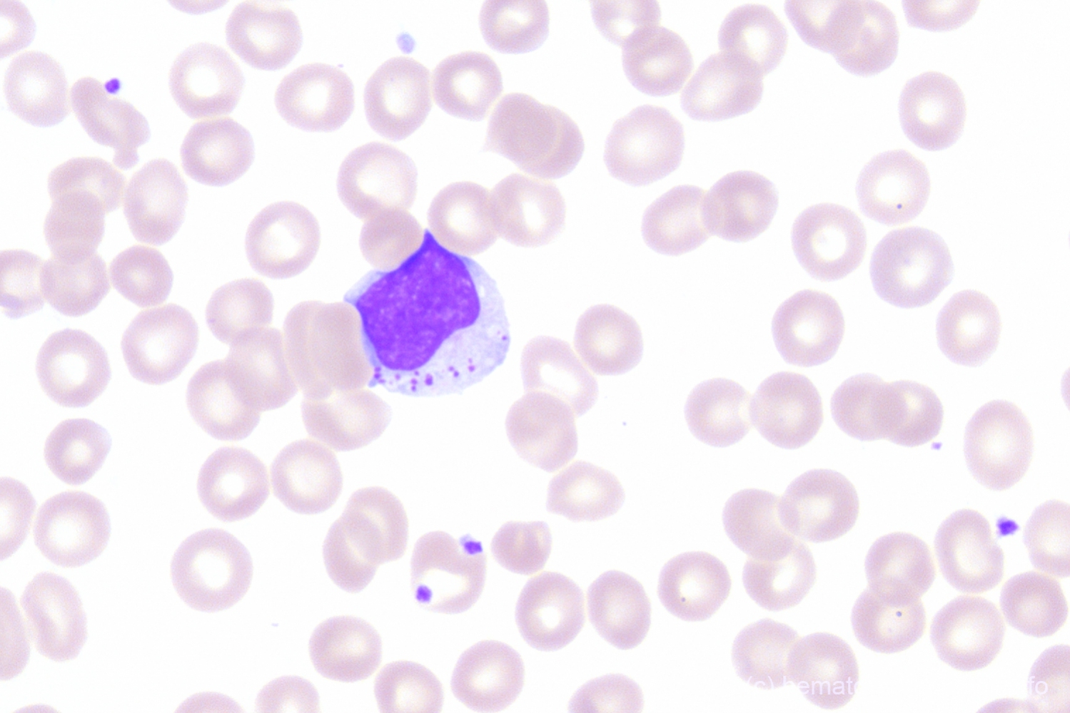 T-cell Large Granular Lymphocyic leukemia (T-LGL) - Hematomorphology, a ...