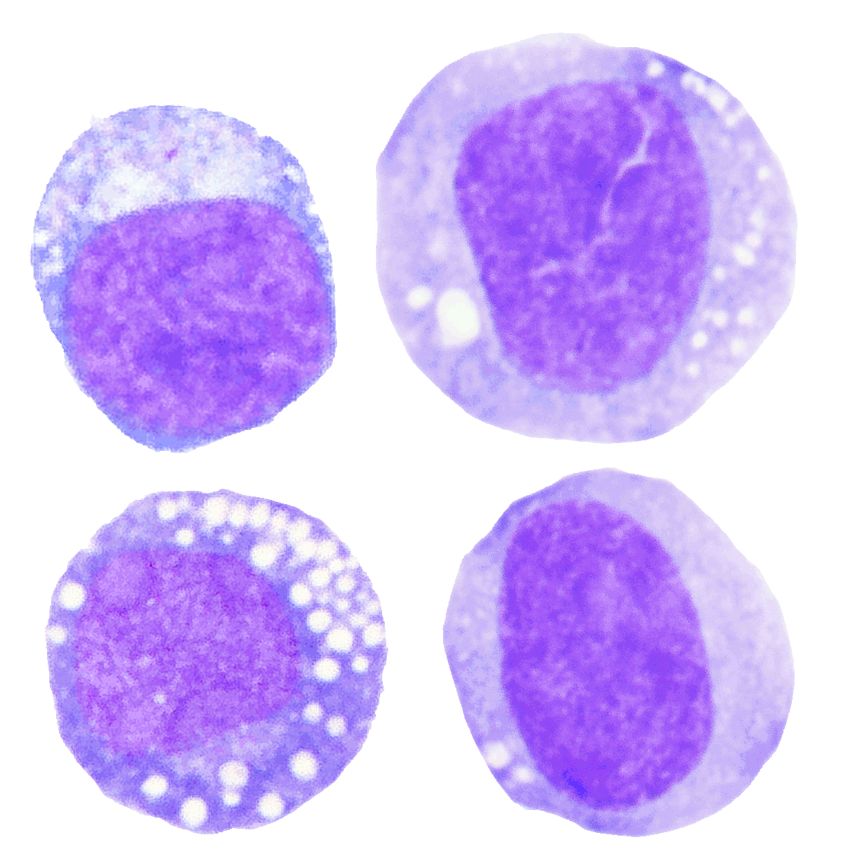 Differentiating Blasts - General Characteristic - Hematomorphology, A ...